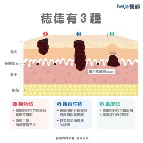 脖子突然長很多痣|痣變大、痣多或長毛會變皮膚癌？認識痣的形成與原因